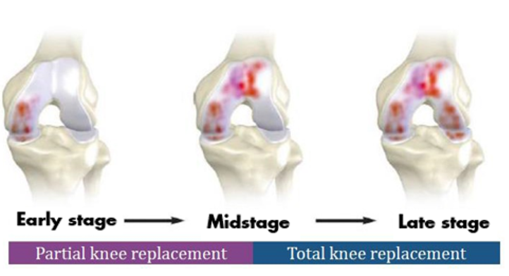 Mako Smartrobotics for Joint Replacement