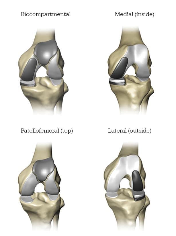 Mako Smartrobotics for Joint Replacement