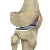 Chondromalacia Patella