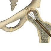 Core Decompression for Avascular Necrosis of the Hip