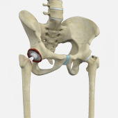 Correction of a Failed Hip Replacement