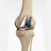 Painful or Failed Total Knee Replacement