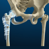 Hip Fracture ORIF