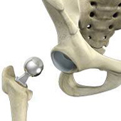 Hip Hemiarthroplasty