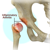 Inflammatory Arthritis of the Hip