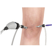 Knee Arthroscopy