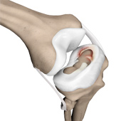 Meniscal Tears