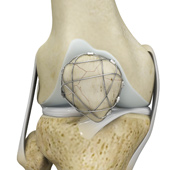 ORIF of the Knee Fracture