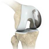 Partial Knee Replacement