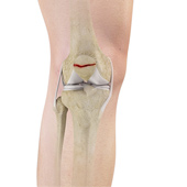 Patella Fracture