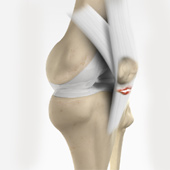 Patellar Tendon Repair