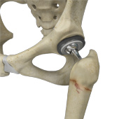 Periprosthetic Hip Fractures