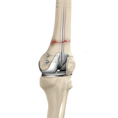 Periprosthetic Knee Fracture Fixation