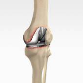 Revision Knee Replacement