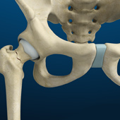 Subtrochanteric Hip Fracture